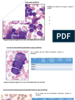 Ejercicio Morfología Leucemias 2010 Sandra Quijano