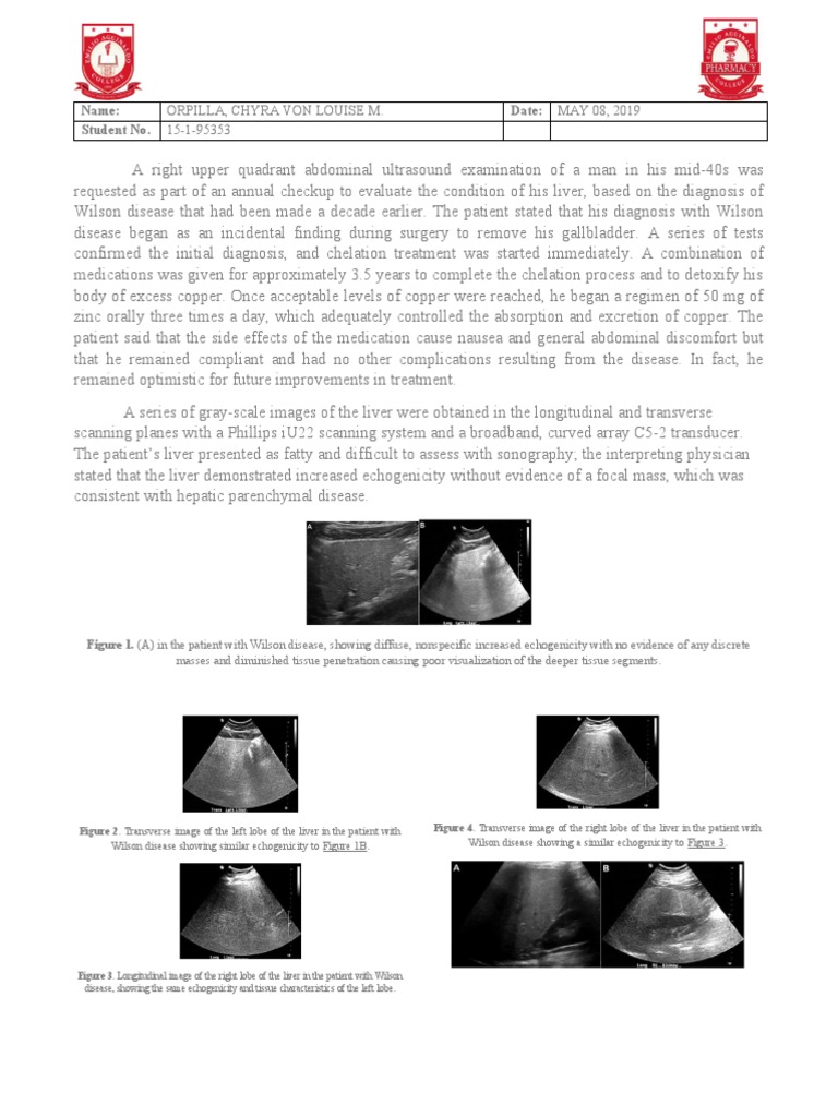 Wilson Disease | PDF | Liver | Medical Ultrasound