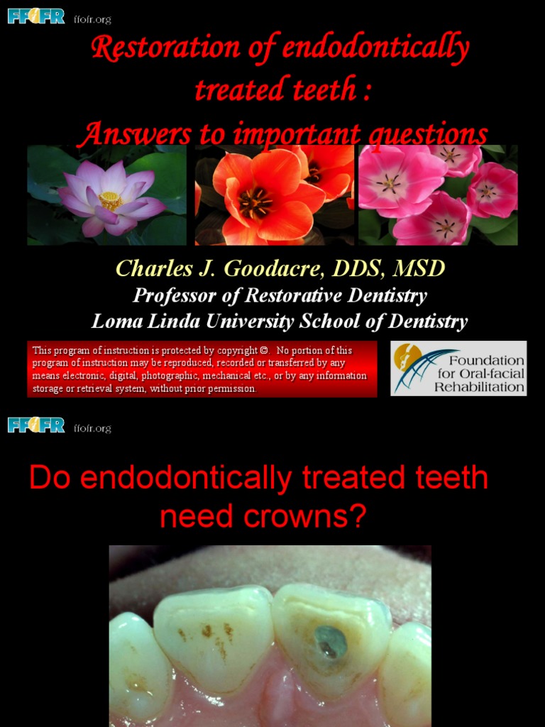 Restoration of Endodontically Treated Teeth | Download Free PDF | Tooth ...