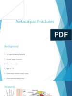 Metacarpal Fractures1