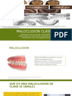 Maloclusion Clase III