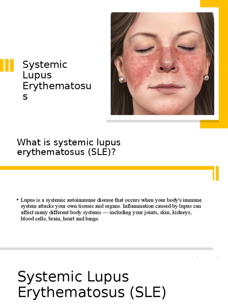 Systemic Lupus Erythematosus Immunology
