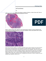 ENTJ-2010-10 - Salivary Gland Acinic Cell Carcinoma PDF