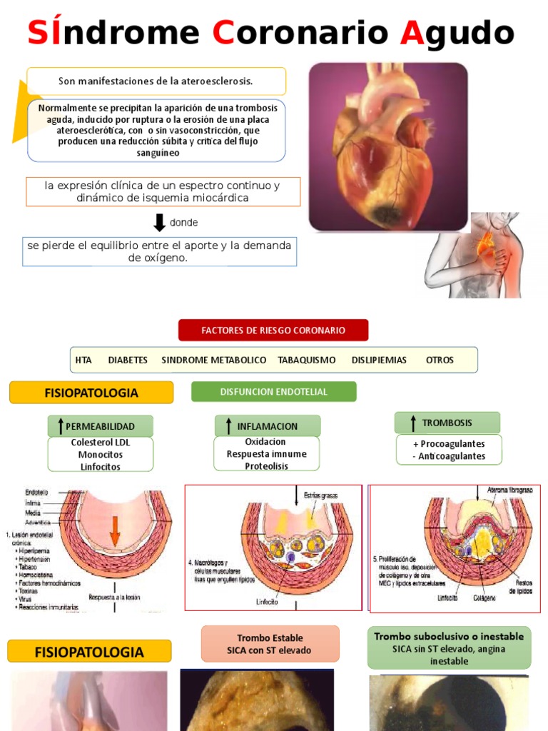 SICA | PDF | Electrocardiografia | Infarto de miocardio