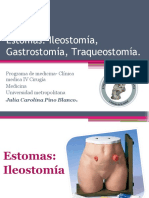 Estomas, Ileostomia