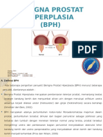 Benigna Prostat Hiperplasia (BPH)
