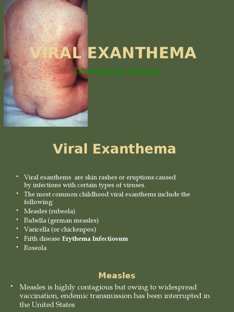 Viral Exanthema Dharmendra Mandal Pdf Measles Infection