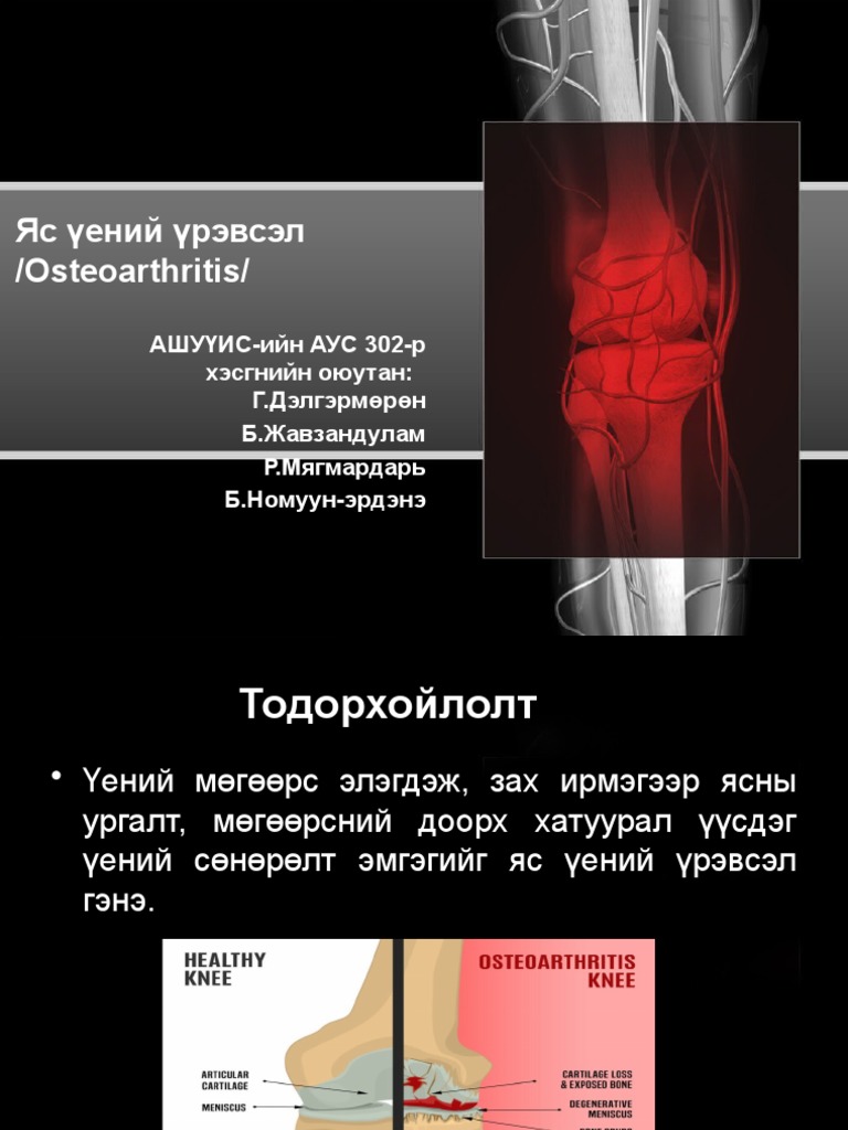 Яс үений үрэвсэл | PDF