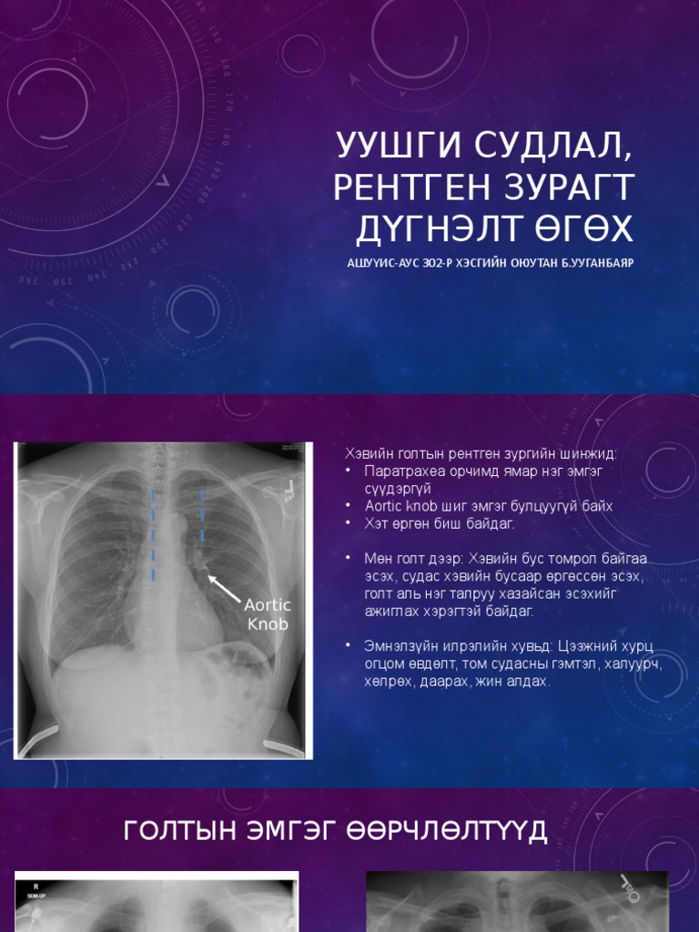 Уушги судлал, рентген зурагт дүгнэлт өгөх | PDF