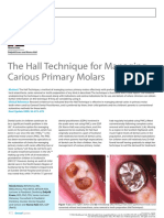 The Hall Technique For Managing Carious Primary Molars: Dentistry