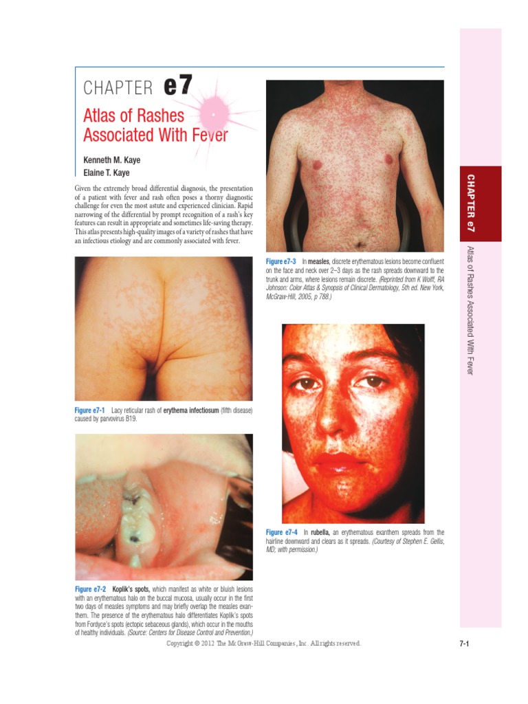 Fever With Rash Atlas PDF | PDF | Systemic Lupus Erythematosus ...