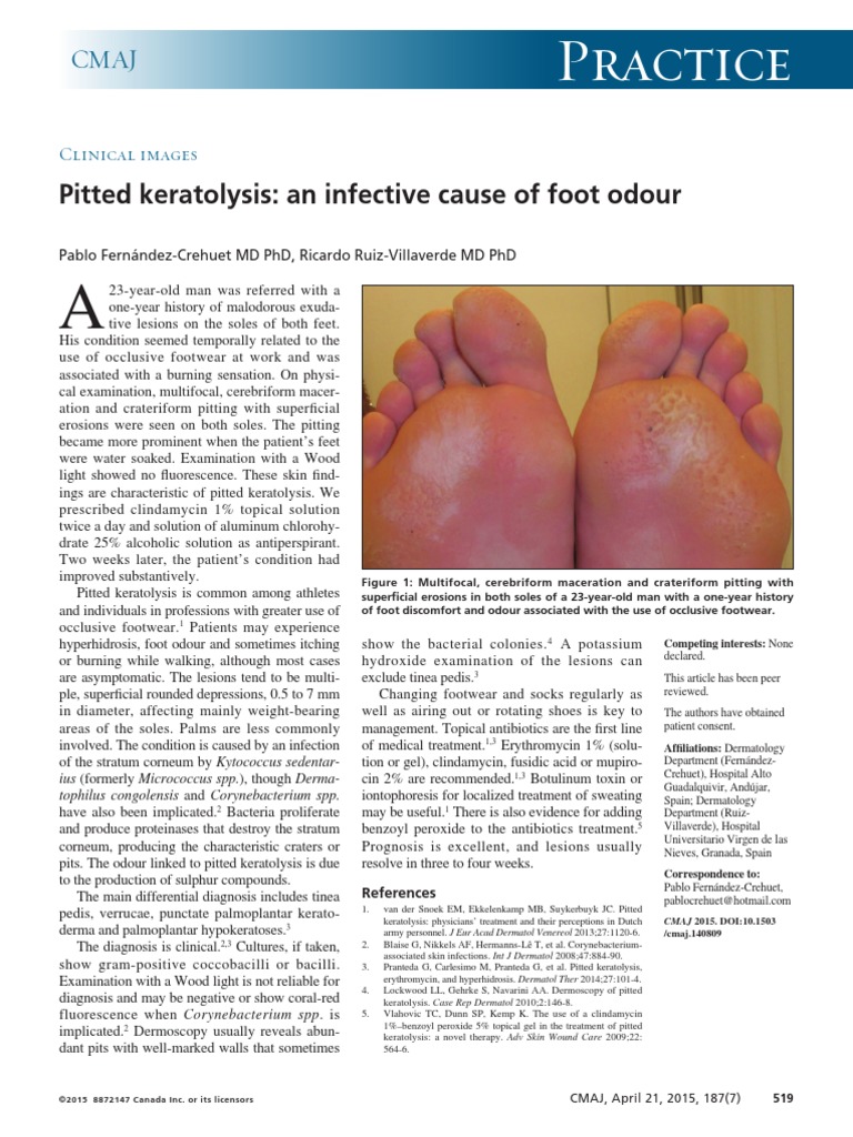 Practice Pitted Keratolysis An Infective Cause of Foot Odour PDF