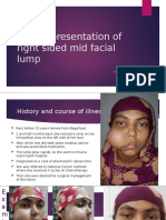 A Case Presentation of Right Sided Mid Facial Lump: BY Dr. Ryfat Hossain Ms ( (Resident) Phase B Omfs Bsmmu