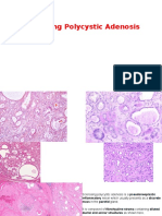 5 Sclerosing Polycystic Adenosis