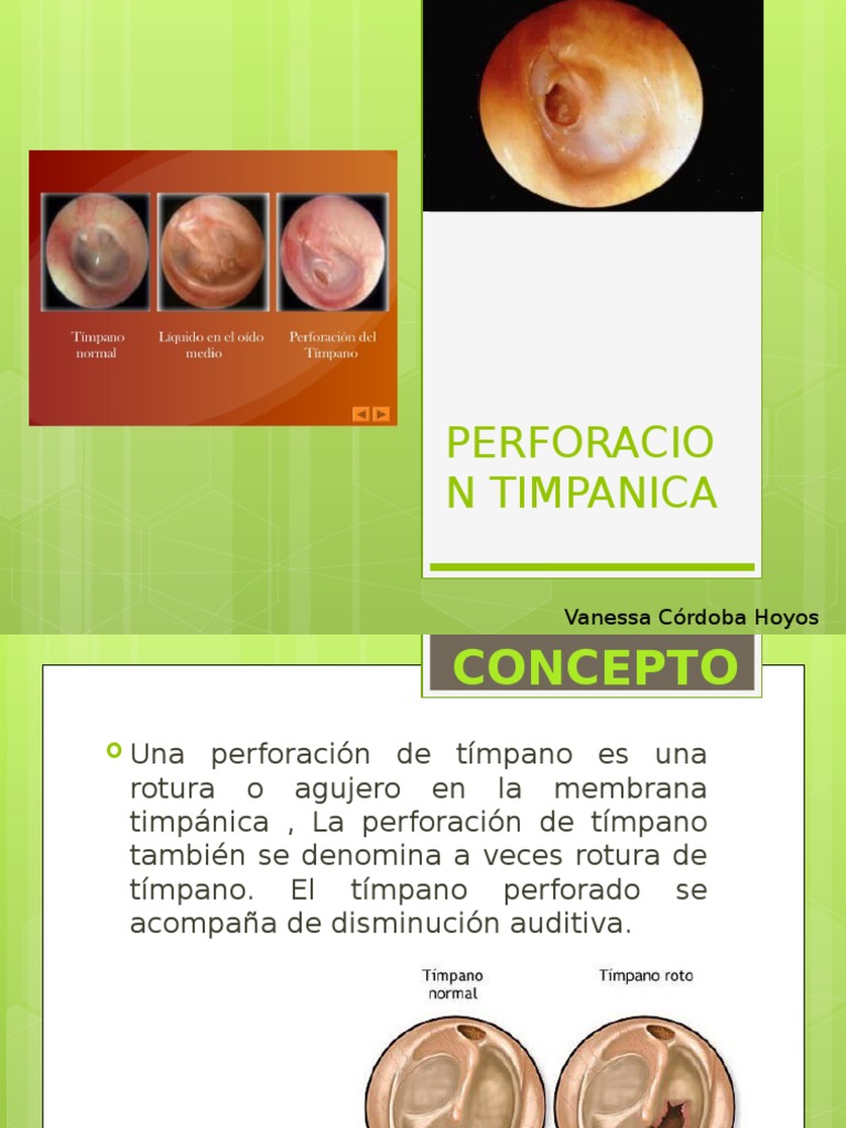 Perforacion Timpanica | PDF | Oído | Lesión