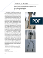 Traumatic Peroneal Artery Pseudoaneurysm: Use of Preoperative Coil Embolization