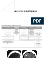 Calcificaciones patológicas en tumores y lesiones cerebrales