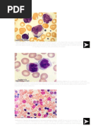 Linfócitos atípicos - leucemias