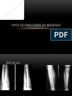 Tipos de Fracturas en Imágenes