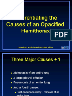 Recognizing Opacified Hemithorax