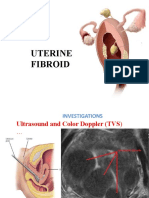 FIBROID UTERUS-Part 2.pptx