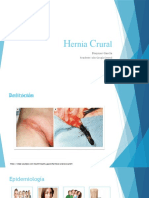 Hernia Crural - Clase II