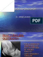 Fracturas de Olecranón