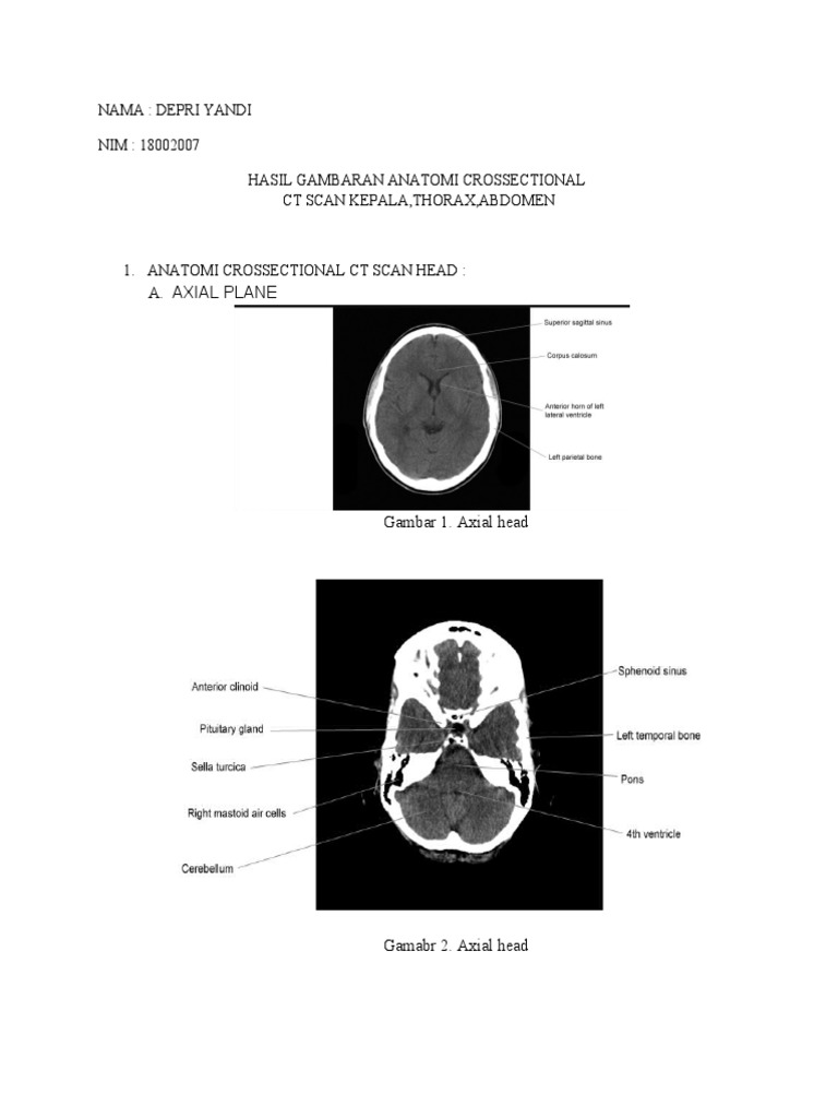 Crossectional CT Scan Anatomy Overview | PDF