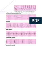 PALS Trazos EKG