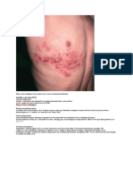 Herpes Zoster (Shingles) : Varicella Zoster Virus (VZV)