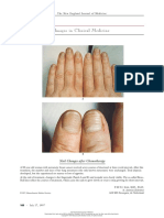 Images in Clinical Medicine: Nail Changes After Chemotherapy
