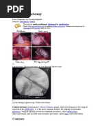 Laparoscopic Cholecystectomy Overview | PDF | Gallbladder | Liver