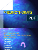 Pneumothoraks