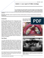 Peeping Through Heart's Window: A Case Report of Fallots Tetralogy