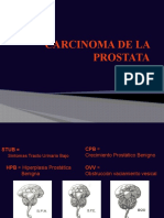 CARCINOMA Prostata
