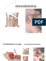 Fin Cricotiroidotomía