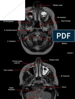 ATLAS T1 Y T2 cerebro