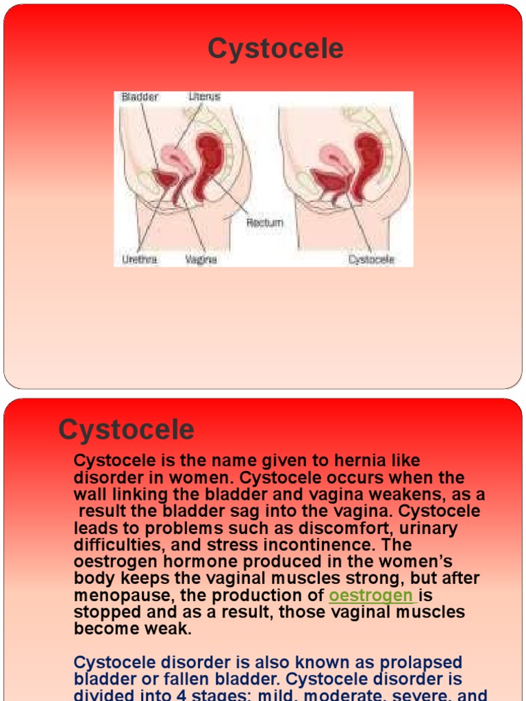 Cystocele | Download Free PDF | Urinary Incontinence | Vagina