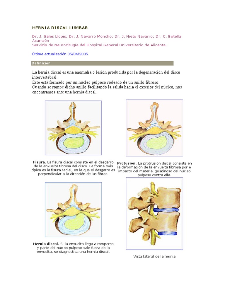 Hernia Discal Lumbar: Causas y Tratamiento | PDF | La columna vertebral ...