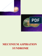 4 Meconium Aspiration Syndrome