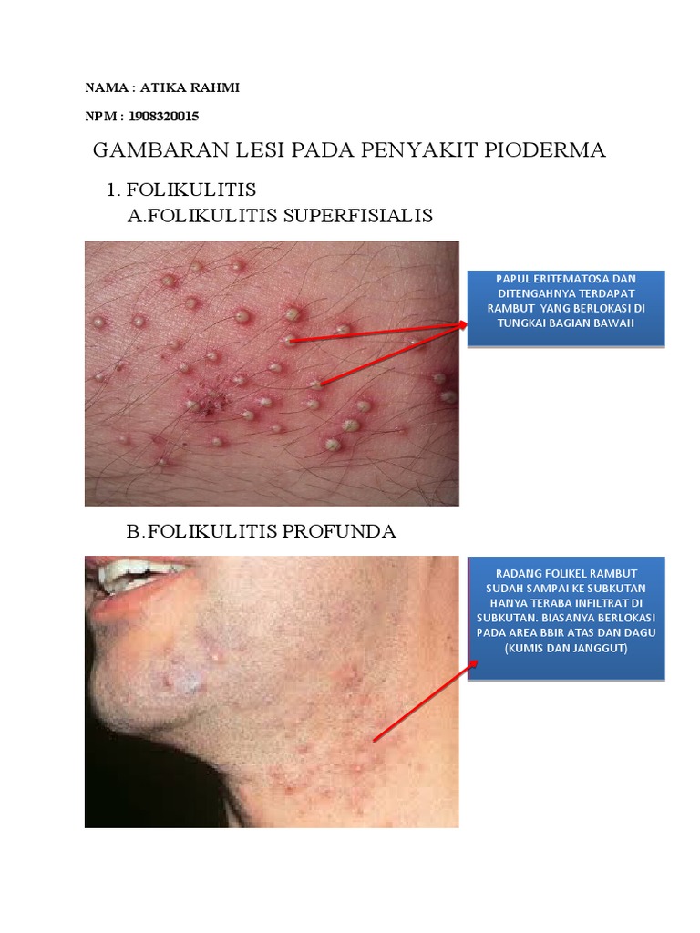 Gambar Pioderma | PDF | Sains & Matematika | Dewasa Muda