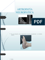 Artropatía Neuropática