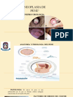 Nefro Urologia Neoplasia de Pene