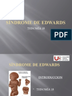 Síndrome de Edwards.
