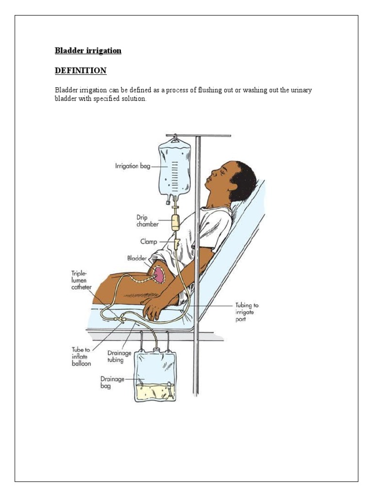 Bladder Irrigation PDF Urinary Bladder Catheter