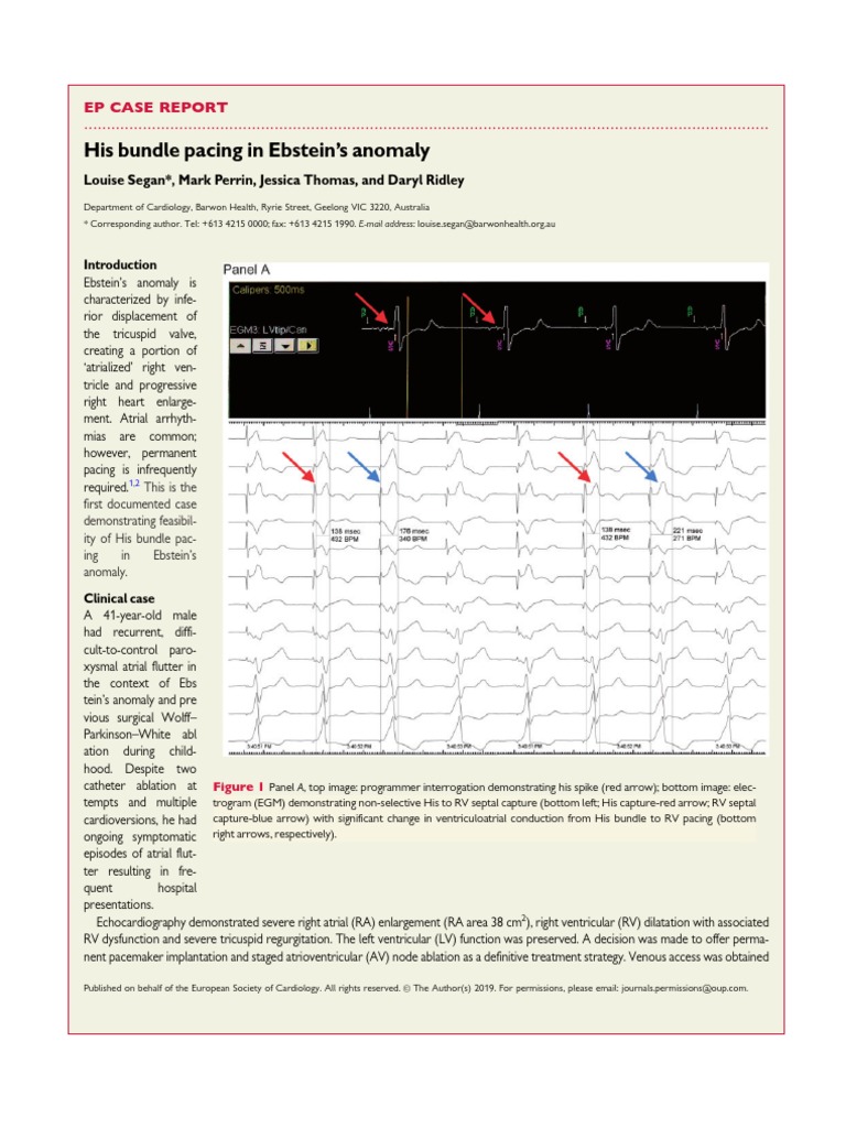 His Bundle Pacing in Ebstein's Anomaly Ep Case Report Download Free
