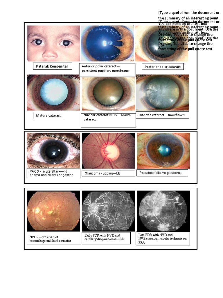 Posterior Polar Cataract Anterior Polar Cataract - Persistent Pupillary ...