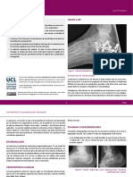 Dan Putineanu - Fractures Du Calcaneum