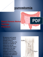 Yeyunostomía