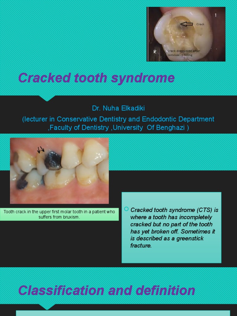 Understanding Cracked Tooth Syndrome | PDF